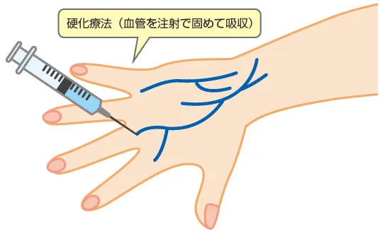 硬化療法について