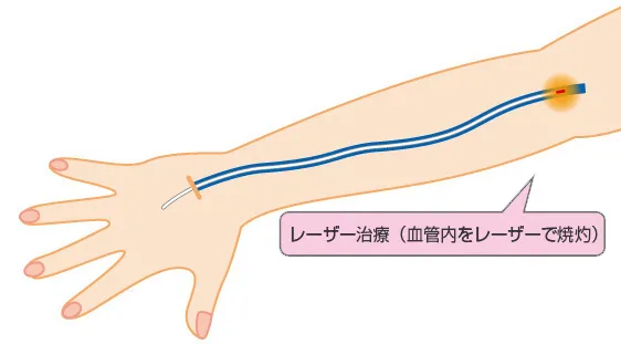 レーザー治療について
