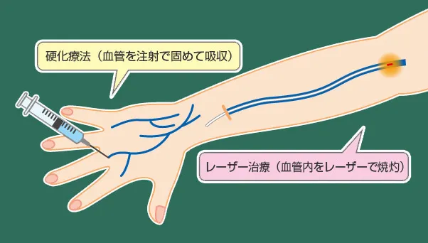 赤羽ウェルネスクリニックの治療法 硬化療法とレーザー治療の同時施行