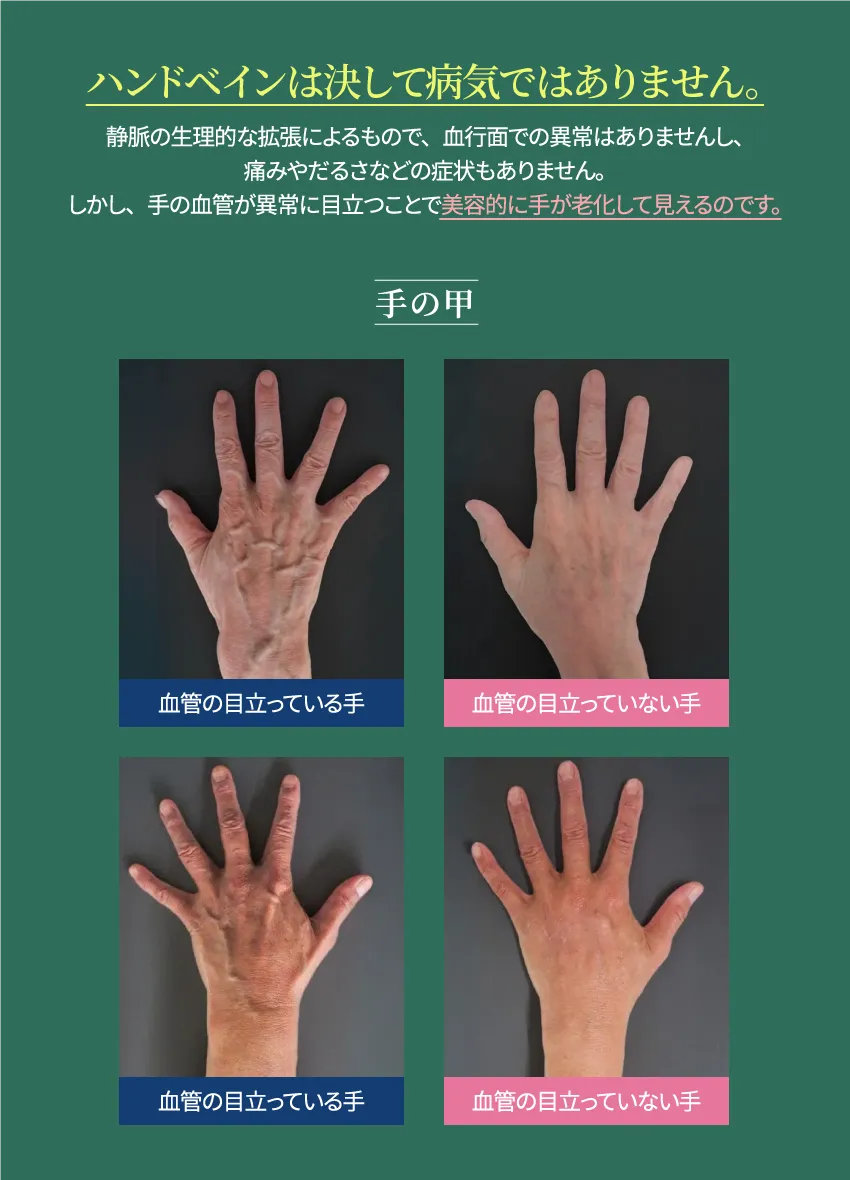 ハンドベインは決して病気ではありません。