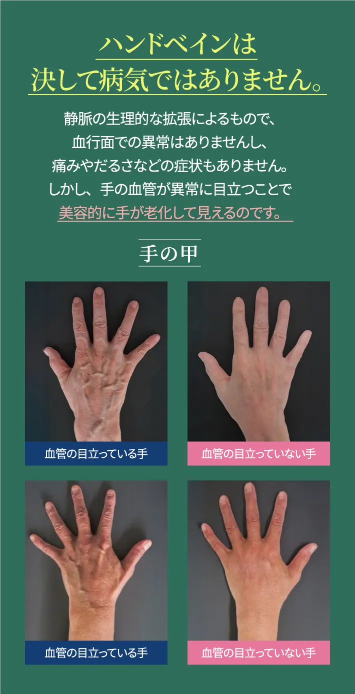 ハンドベインは決して病気ではありません。