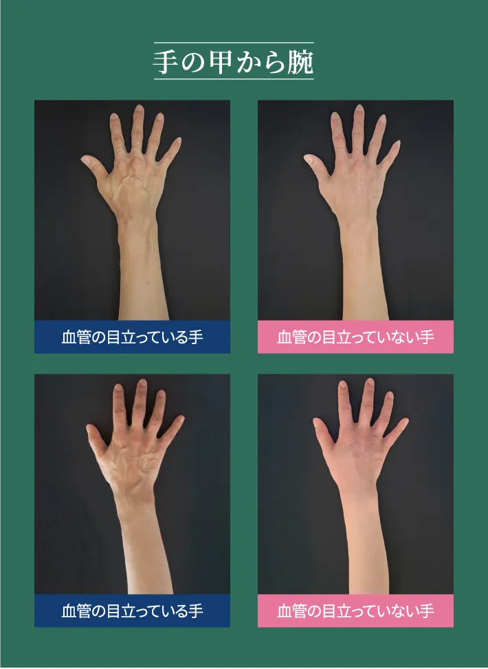 ハンドベインは決して病気ではありません。