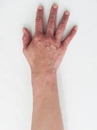 ハンドベイン 手 腕の血管 症例写真 赤羽静脈瘤クリニック 東京
