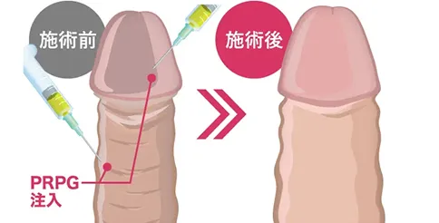 PRPG注射による施術前と施術後のイメージ