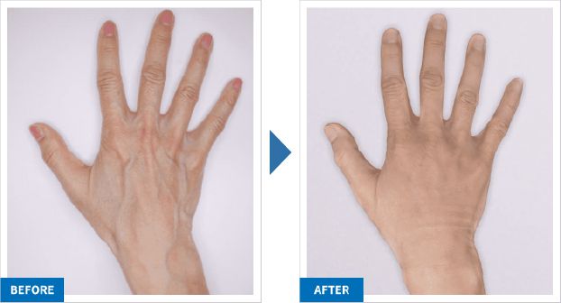レーザー治療と、PRP皮膚再生治療・硬化療法の併用について