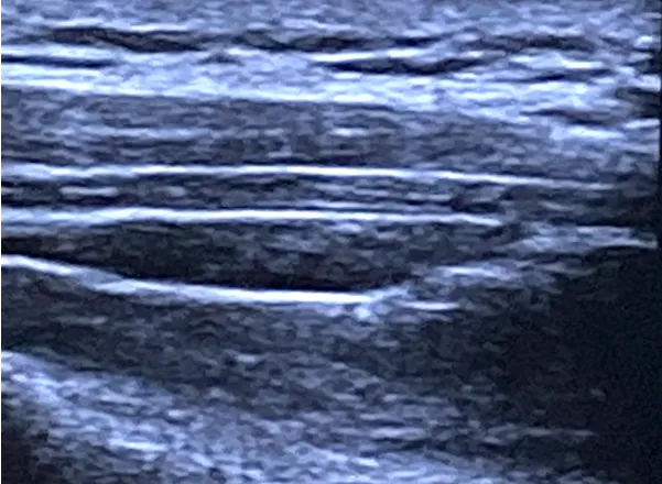 筋膜に水が入り、剥がれた状態（赤矢印でさした黒い部分が水）