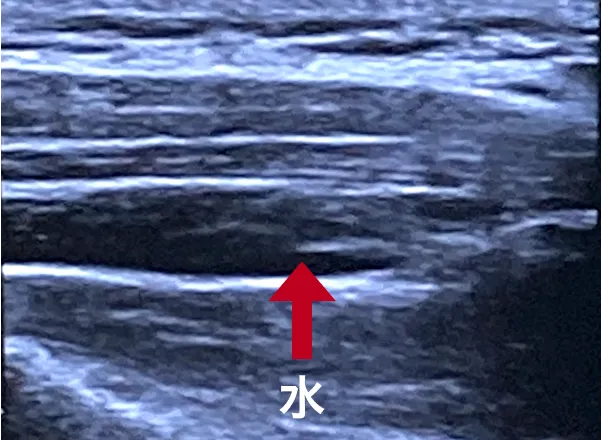 筋膜に水が入り、剥がれた状態（赤矢印でさした黒い部分が水）