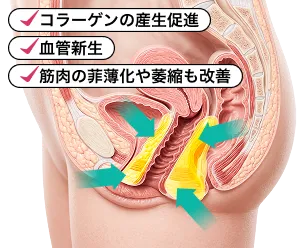 施術後の膣粘膜イメージ