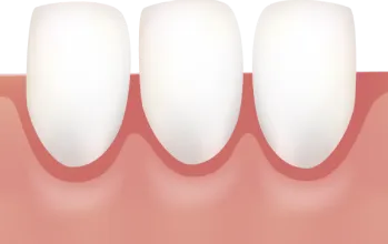 健康的な歯肉の状態（歯茎がしっかりと歯根を覆っている）