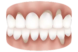 加齢や歯周病により歯肉が退縮し歯根が露出した状態