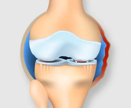 中期の変形性ひざ関節症の断面図：半月板が変形し水がたまった状態