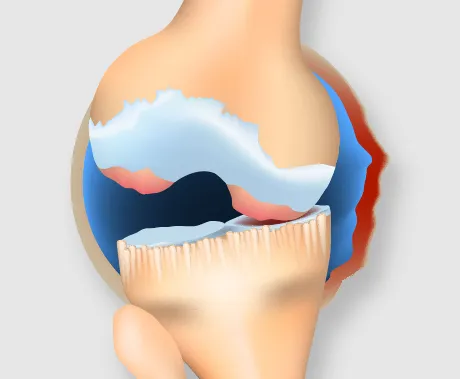 末期の変形性ひざ関節症の断面図：骨が損傷しひざが変形した状態