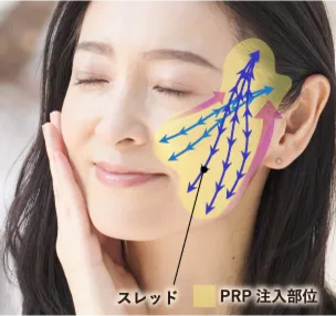 スレッドとPRPによる リフトアップ肌再生効果