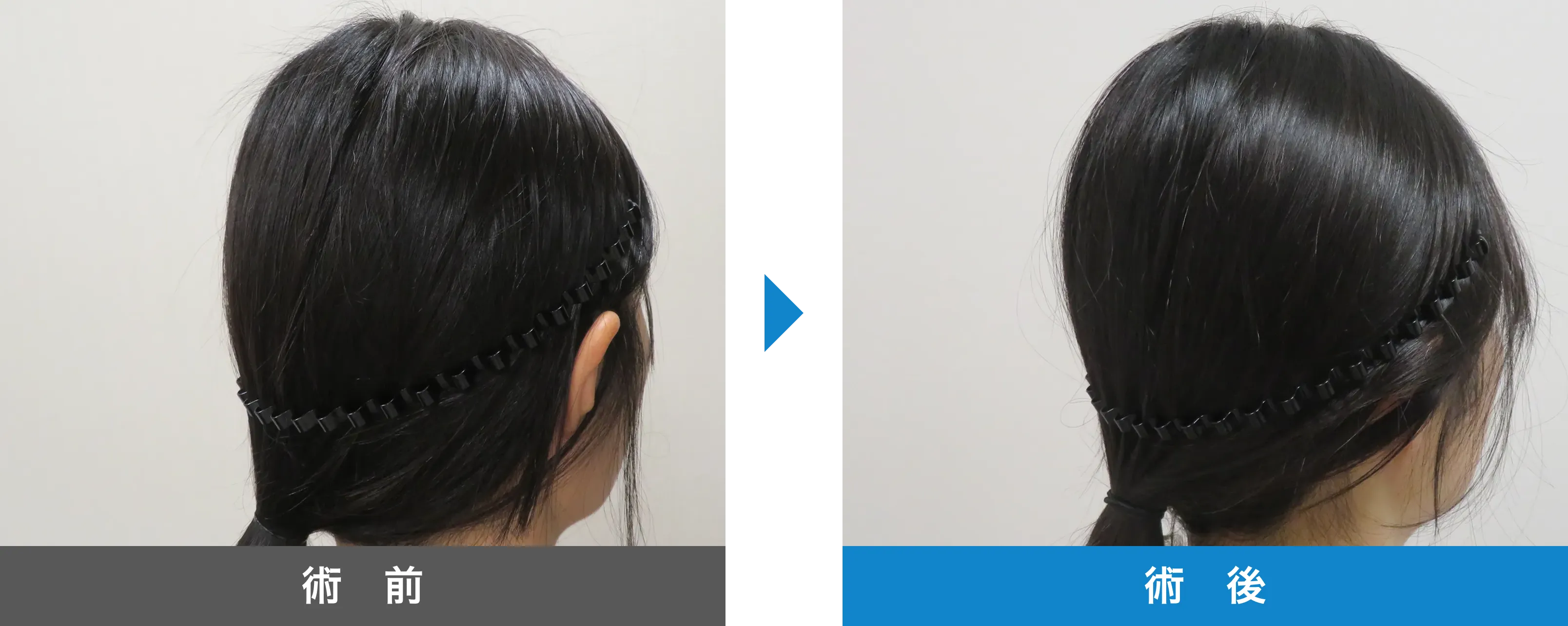 後頭部形成術 症例写真 術後