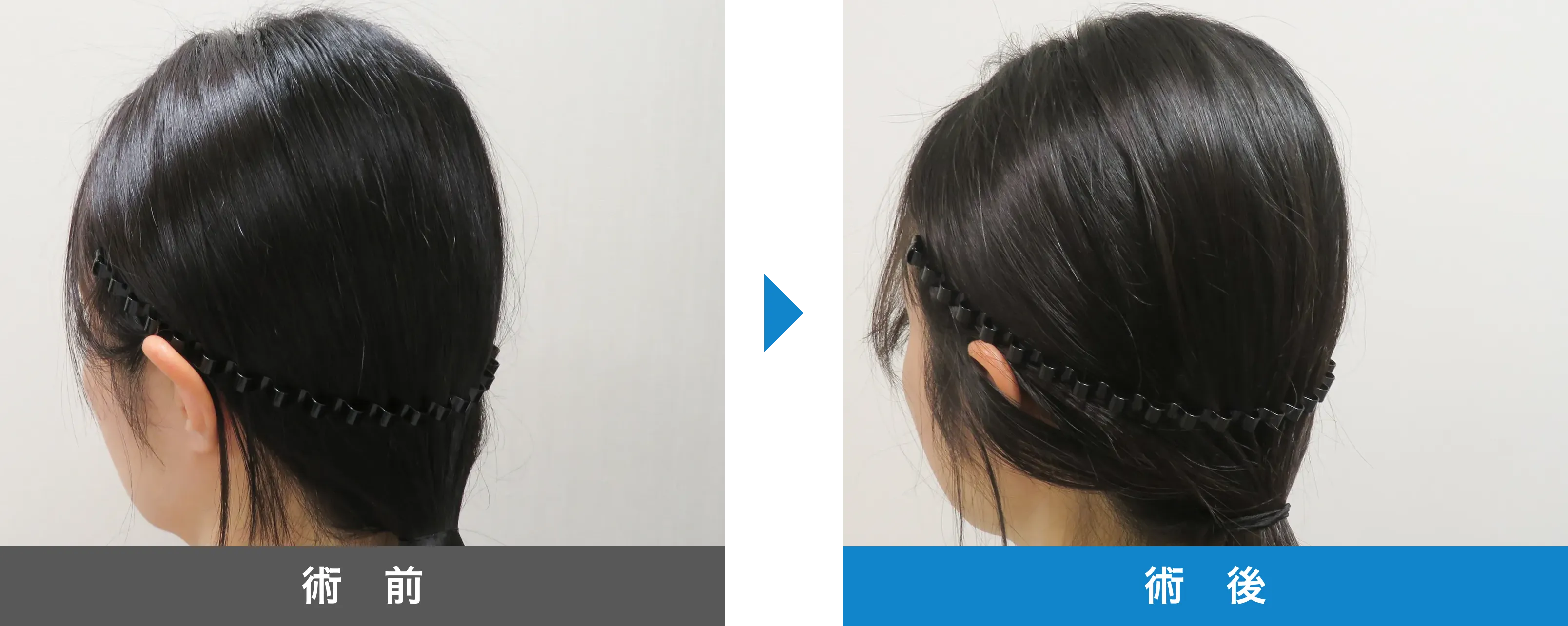 後頭部形成術 症例写真 術後