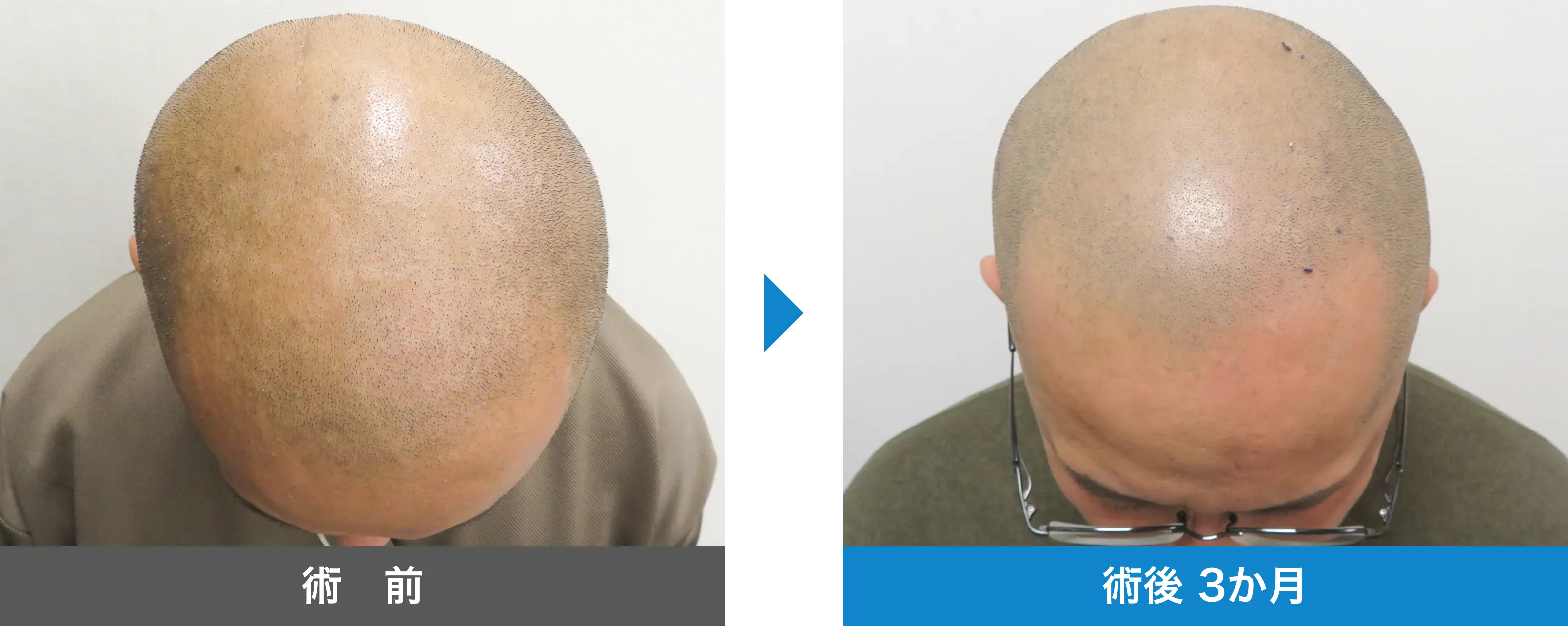 後頭部形成術 症例写真 術後 3か月