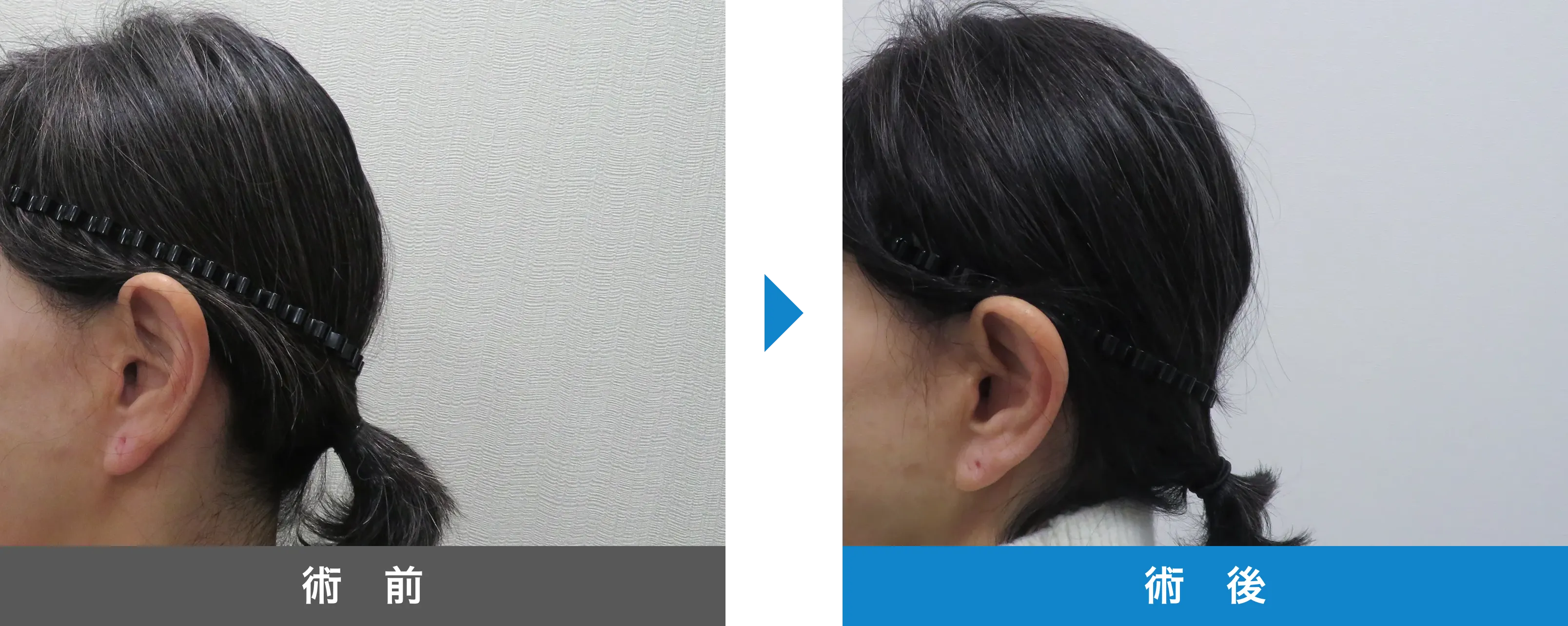 後頭部形成術 症例写真 術後