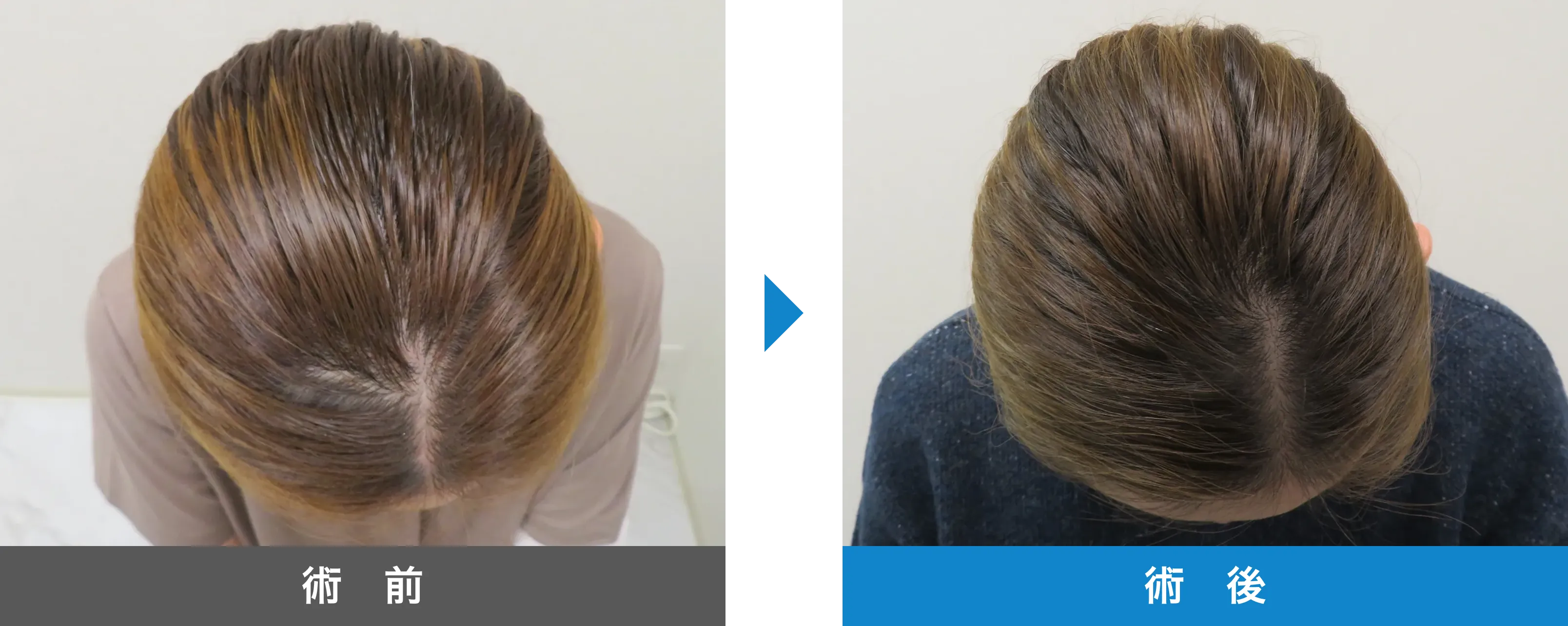 後頭部形成術 症例写真 術後