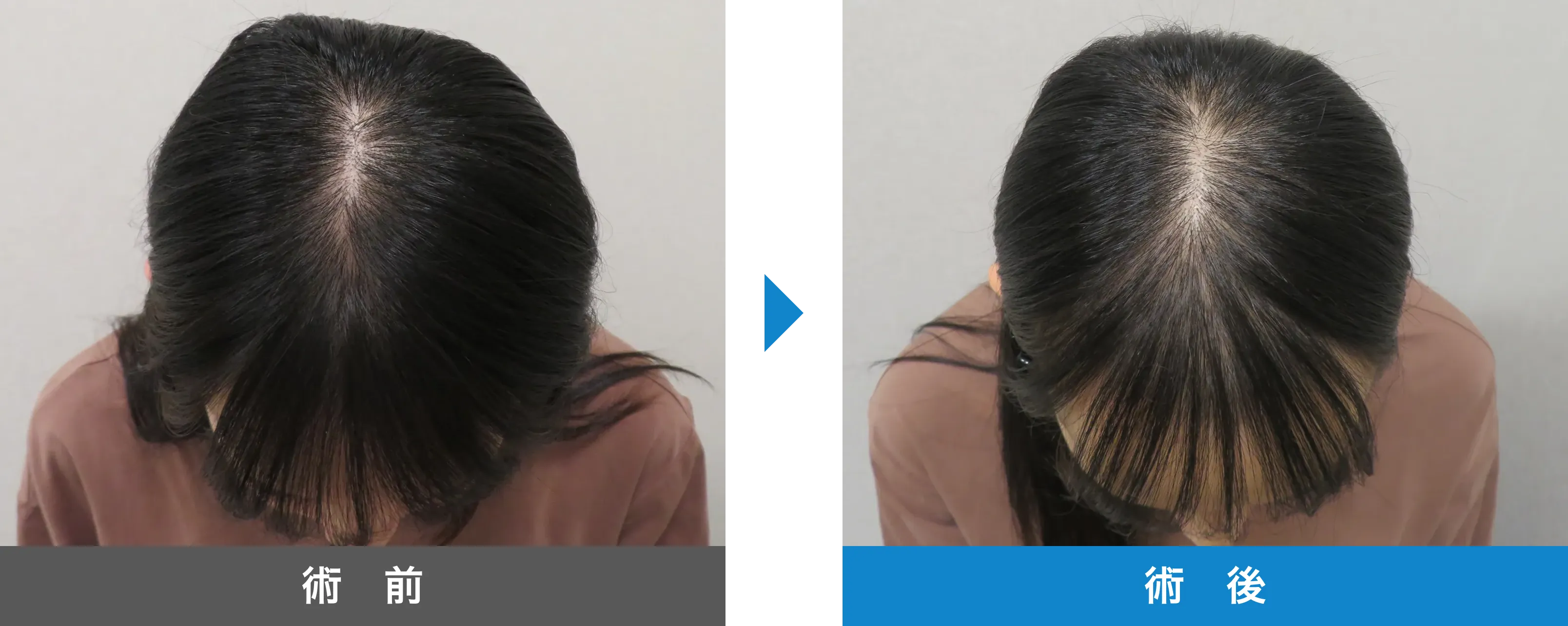 後頭部形成術 症例写真 術後