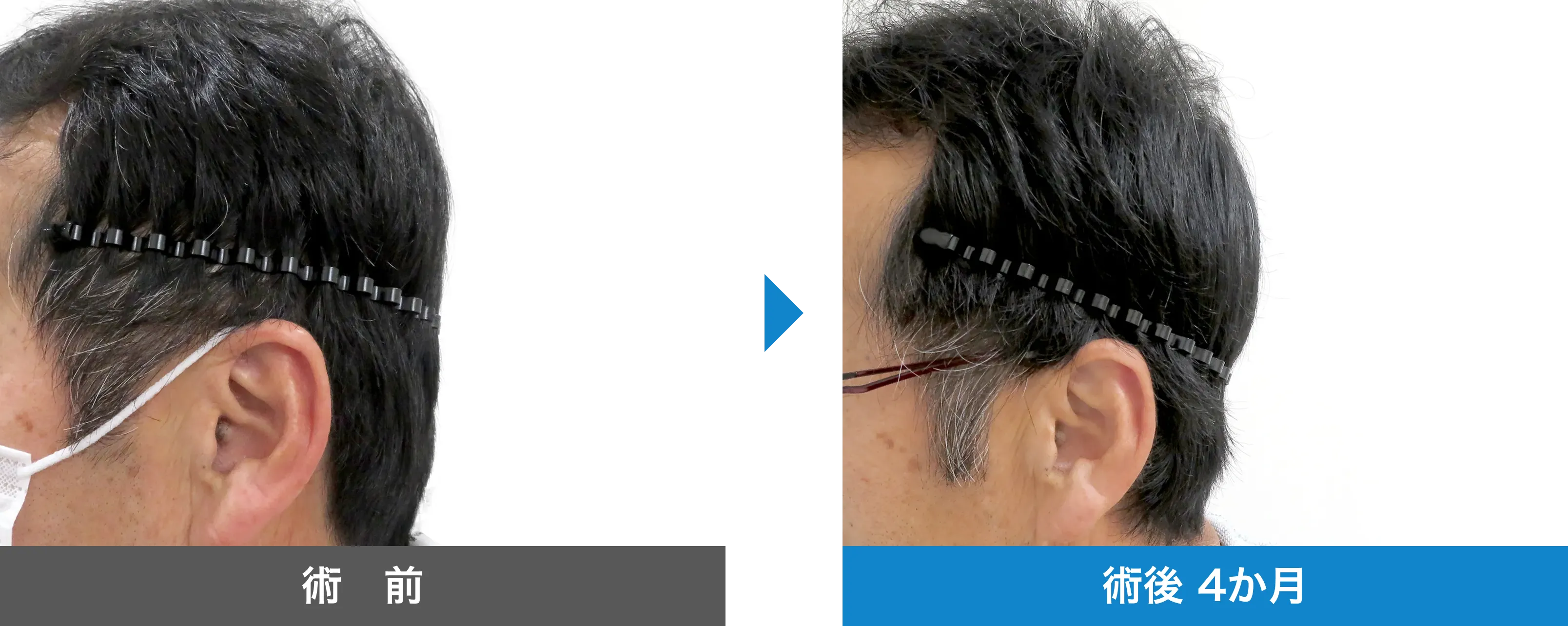 後頭部形成術 症例写真 術後 4か月