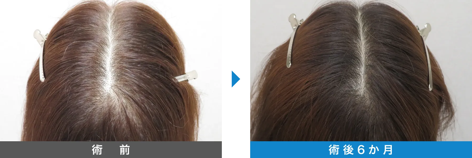 w-スカルプ 症例写真 術後 6か月