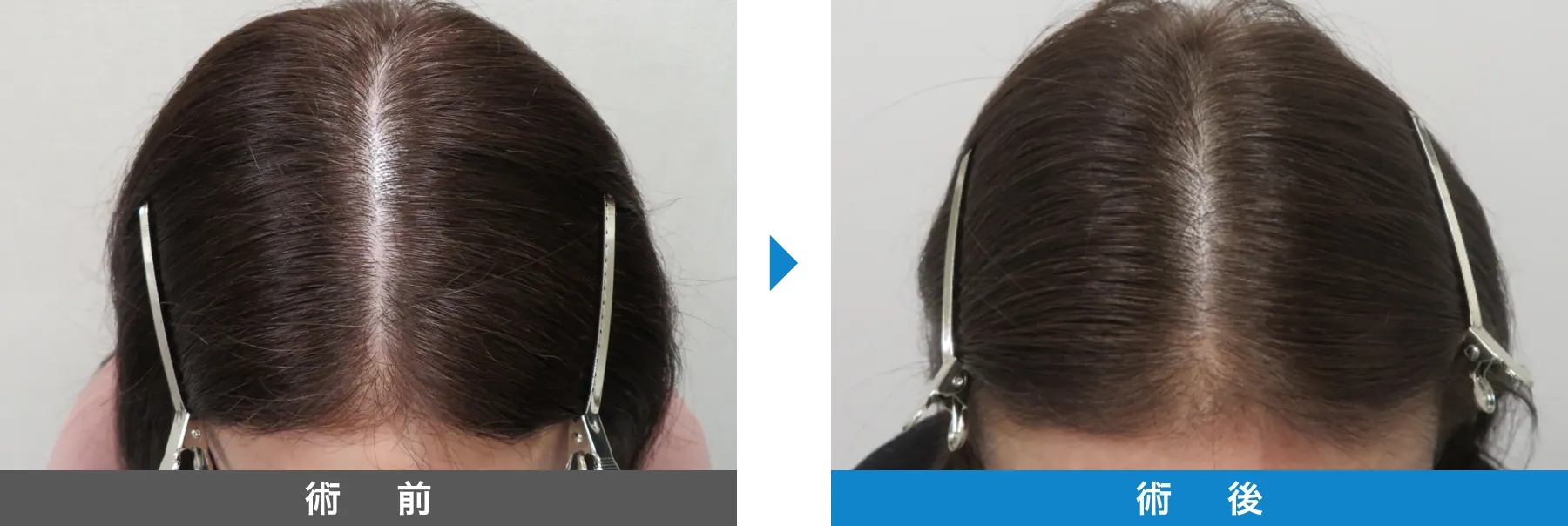 w-スカルプ 症例写真 術後