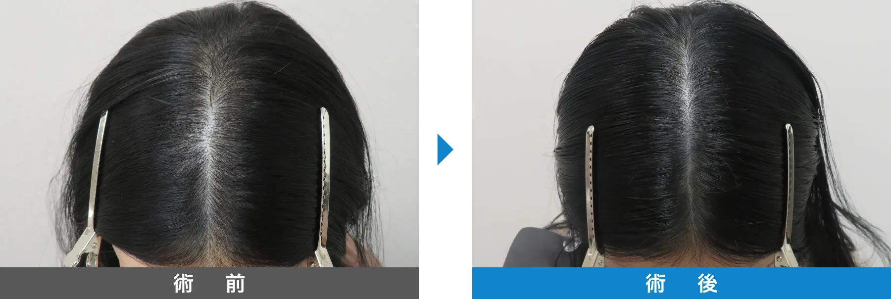 w-スカルプ 症例写真 術後