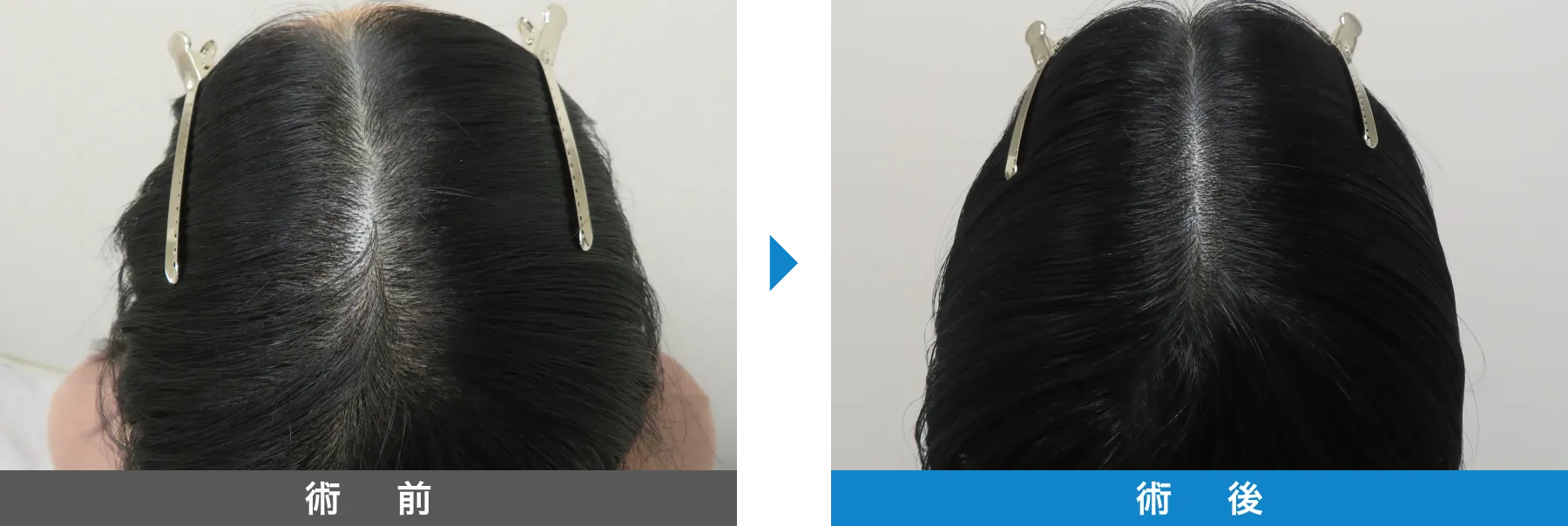 w-スカルプ 症例写真 術後