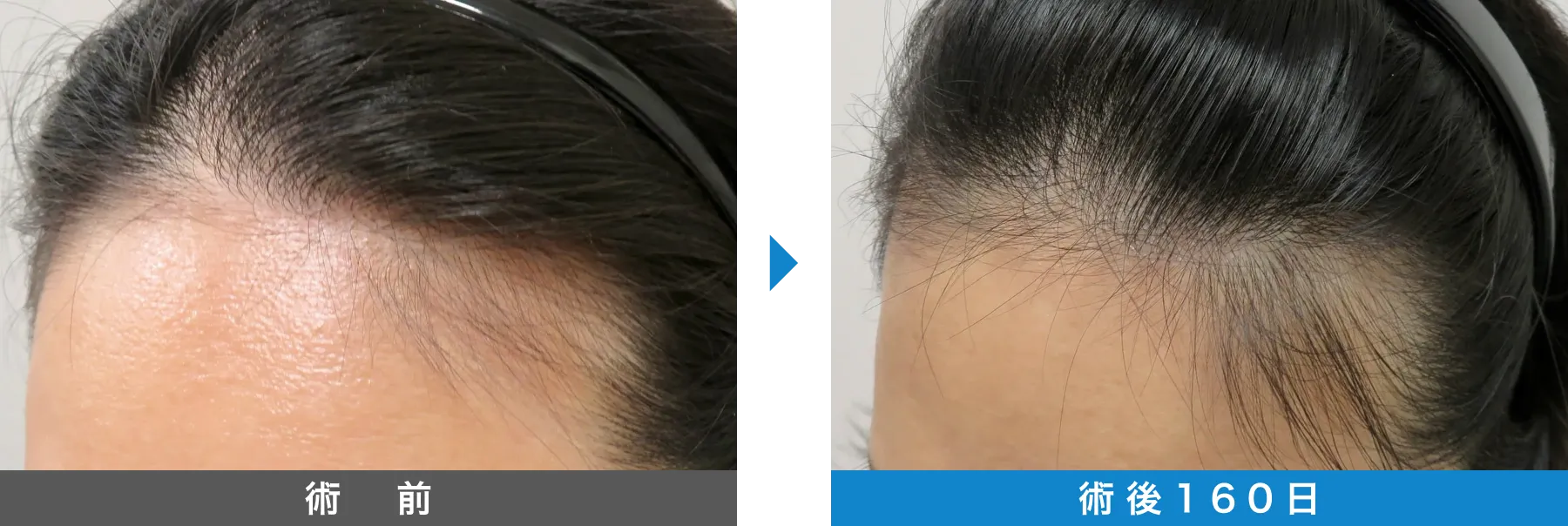 w-スカルプ 症例写真 術後 160日
