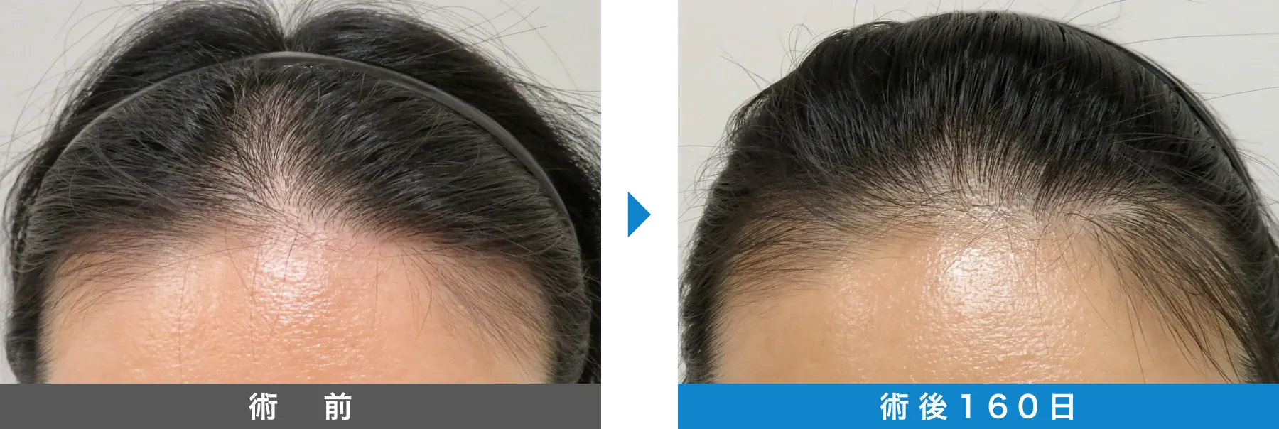 w-スカルプ 症例写真 術後 160日