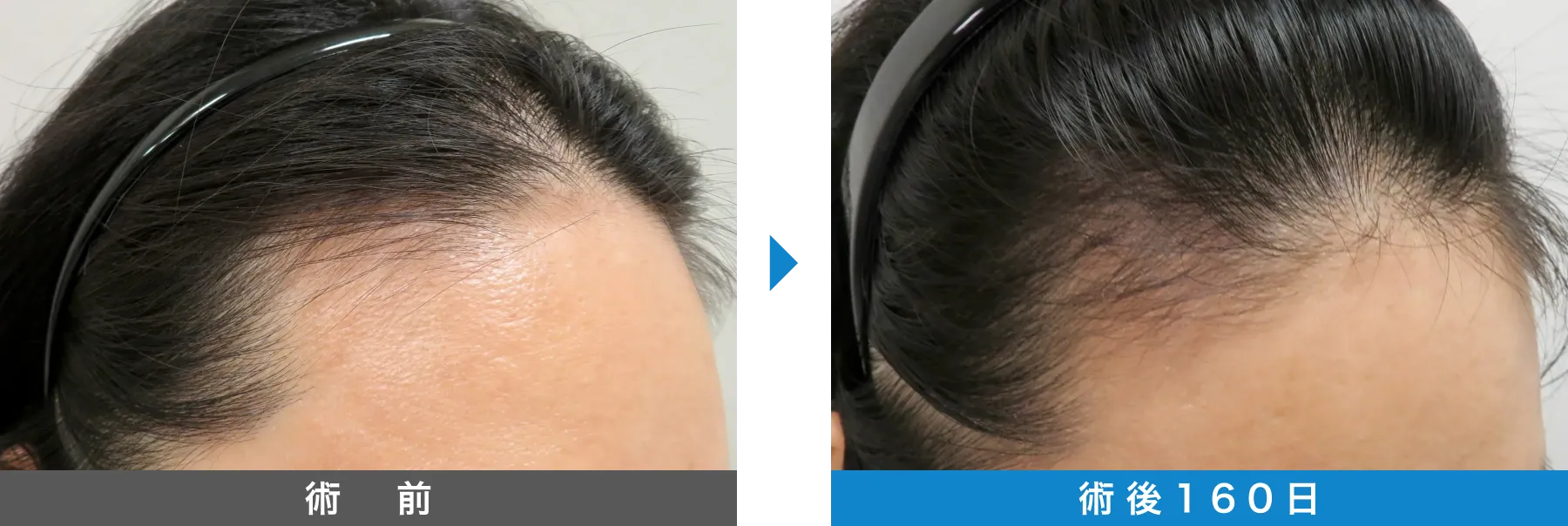 w-スカルプ 症例写真 術後 160日