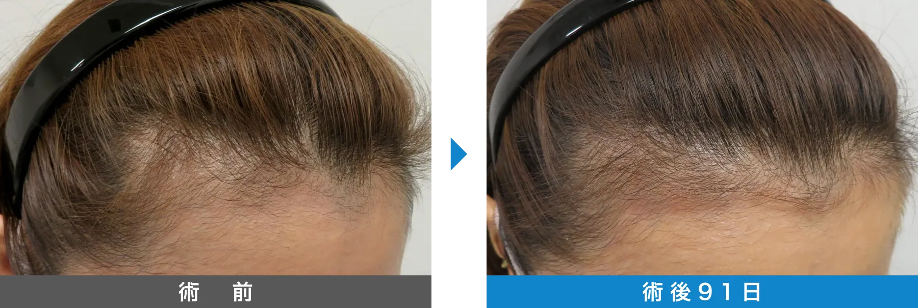 w-スカルプ 症例写真 術後 91日