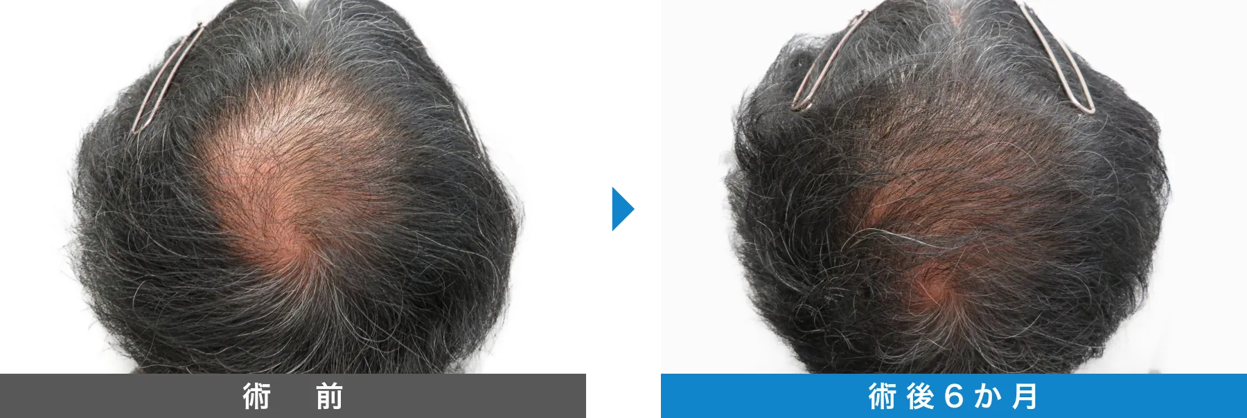 w-スカルプ 症例写真 術後 6か月