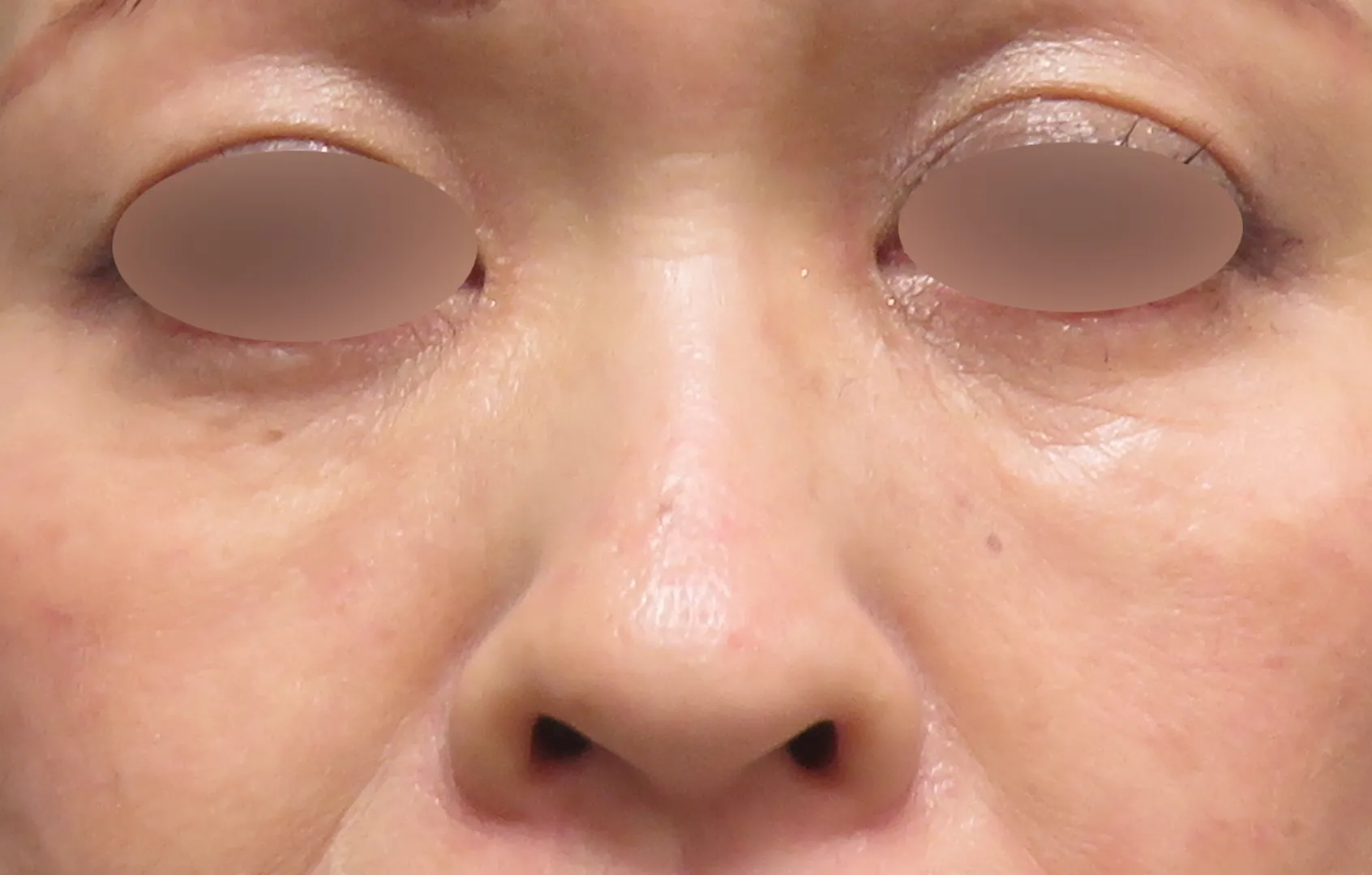 赤羽ウェルネスクリニック PRPG修正注射 目の下 症例（術後）
