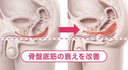 骨盤底筋・陰部神経の衰えと前立腺手術の影響を示す比較図