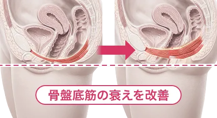 骨盤底筋の衰えと尿道の衰えの比較図