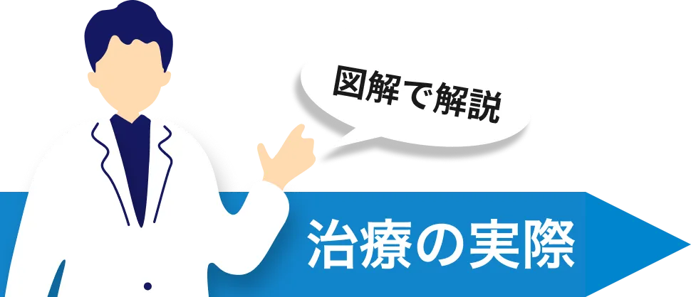 尿道周囲へのPRP注射部位の図解