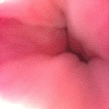 PRP注入前の膀胱鏡画像