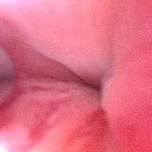 PRP注入後の膀胱鏡画像