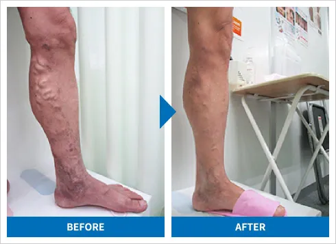 下肢静脈瘤の高周波治療 症例1 施術前後の比較写真