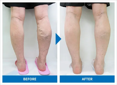下肢静脈瘤の高周波治療 症例2 施術前後の比較写真