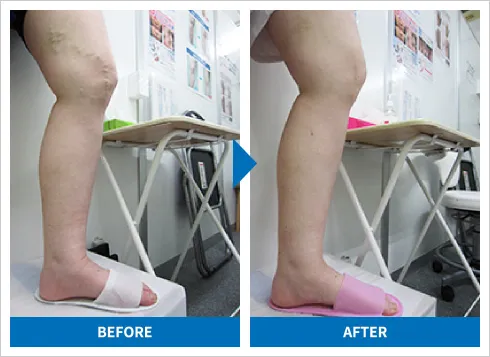 下肢静脈瘤の高周波治療 症例3 施術前後の比較写真