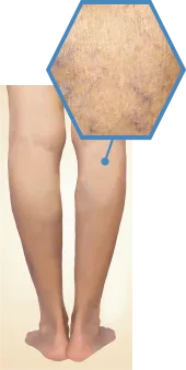 Stage1 くもの巣状静脈瘤の症例写真