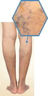 Stage2 網目状静脈瘤の症例写真