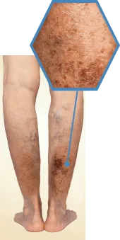 Stage5 潰瘍出血の症例写真