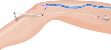 ストリッピング手術による下肢静脈瘤の静脈抜去イメージ