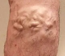 小伏在静脈瘤の発症部位を示すイラスト