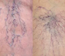 網目状静脈瘤とくもの巣状静脈瘤の症例イラスト