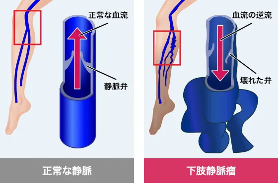 正常な静脈と下肢静脈瘤の比較図
