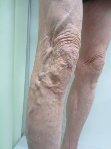 脚の外側の静脈瘤の写真画像